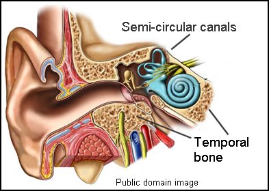 Meniere's Disease